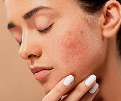 Acne Skin Care